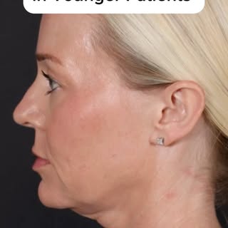 It is not uncommon for younger patients to lack a crisp jaw or neckline. Many patients in this age g