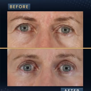 Results by @drtimminton ✨

This patient is 4 months post op from her endoscopic brow lift, upper and