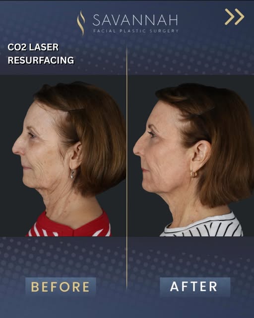 Results by @drtimminton ✨

This lovely patient had a CO2 laser resurfacing treatment. Notice the eve