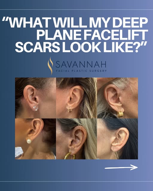 A big concern for patients when it comes to their deep plane facelift is scarring. They often worry 