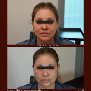 ✨ Facial Balancing & Facial Harmonization with Hyaluronic Acid Gel Fillers✨

A youthful face isn’t a