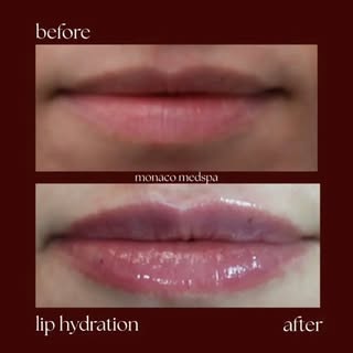 Subtle lip enhancement with half a syringe of Juvéderm’s Volbella Hyaluronic Acid Gel Lip Filler. At