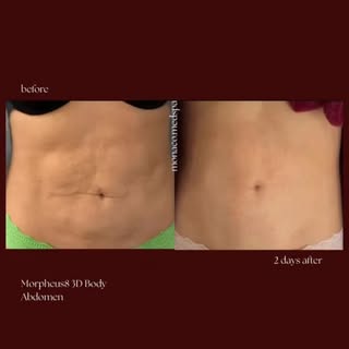 Ready for your summer body? ☀️👙 

Morpheus8 3D BODY Abdomen ✨ is one of the most advanced non-surgi
