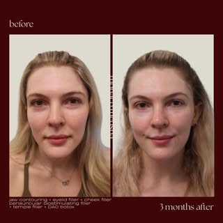✨ Nonsurgical Natural Facial Rejuvenation ✨

Sometimes the most beautiful results come from the smal
