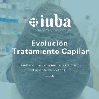 ✨Antonio, 33 años ✨

📩 Inició su tratamiento de Mesoterapia combinada con PRP y tratamiento oral ha
