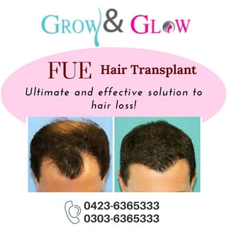 ARE YOU WORRIED ABOUT YOUR HAIR LOSS?
FUE hair tansplant is the best, effective, and ultimate surgic