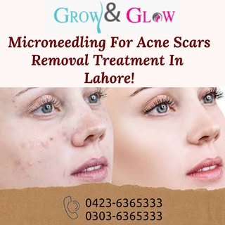 Remove your ACNE SCARS with Microneedling procedural treatment and make your face fair, fresh, and y