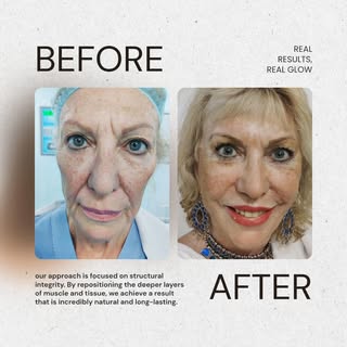 "Glow up! 💫 Want to wake up feeling refreshed and confident? Discover how a facelift can transform 