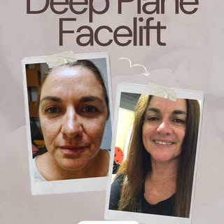 Deep Plane Facelift — lifting not just skin, but confidence.
Natural. Youthful. Long-lasting results