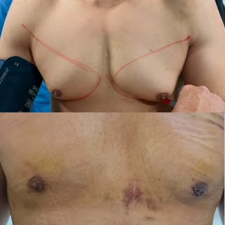 "Uncover your confidence 💪. Gynecomastia surgery helps achieve a firmer, more masculine chest.

📍 