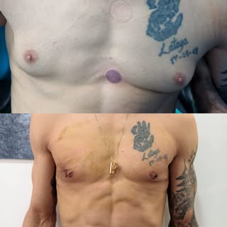 "Say goodbye to unwanted chest fat 🙌. Gynecomastia surgery: sculpt a firmer, more masculine you! 

