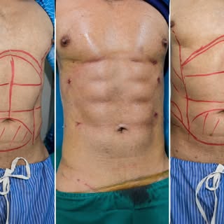 Before ➡️ After | Just 4 days post surgery 🔥
Six Pack Surgery Transformation ✨

#SixPackSurgery #Bo