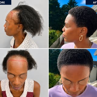 The journey to a fuller hairline begins today. 🌱

Before ➡️ After

Patience, precision, and natural
