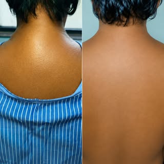 From discomfort to confidence. ✨

This Buffalo Hump Removal procedure highlights the difference that