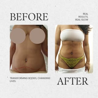 Tummy Tuck + 360° VASER Liposuction ✨ Sculpted waist. Flatter tummy. Beautiful transformation.

🌍 W