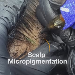 No hair transplant option left?

Advanced baldness doesn’t always mean there are no solutions availa