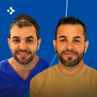 Você já evitou fotos, mudou o ângulo no espelho ou tentou disfarçar as entradas no dia a dia?

Essa 