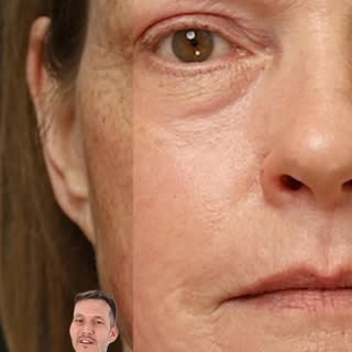 1 KEER LASEREN, 10 JAAR JONGER

Met onze Contour TRL laser verwijderen we in één behandeling decenni