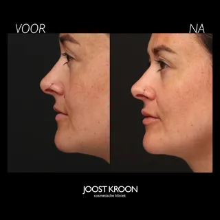 SUBTIELE LIPFILLER
door dokter Michelle Carrière

Lipfiller kan heel subtiel en natuurlijk zijn. Dok