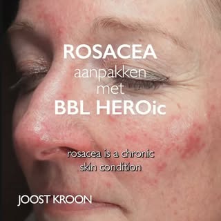 BBL HEROic BIJ ROSACEA

Rosacea is een chronische aandoening, maar we kunnen er zeker bij helpen. Do