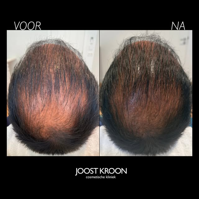 PRP / PRF HAIR
bij Joost Kroon cosmetische kliniek

Bij beginnend haarverlies of na een haartranspla