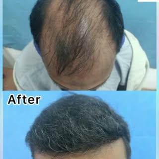 Hair transplantation

For more details contact:
 Cuddalore:9940039202
  Pondicherry-7845839202
  Eme