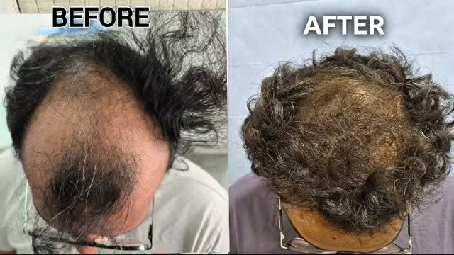 ​✨ Real Transformation, Natural Results! ✨

Swipe/Watch to see the 8-month Hair Transplantation jour