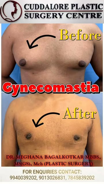 ​Say Goodbye to Gynecomastia! 👨‍⚕️✨

Gynecomastia (male breast enlargement) can be safely and effec