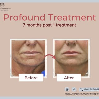 What is a profound face treatment? The Profound face treatment uses radiofrequency energy and micron