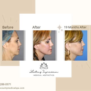 DO YOU WANT AN INSTANT FACELIFT? PDO Thread Lift not only provides you an immediate lift but also re