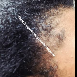 This client is experiencing traction alopecia due to excessive tension from braids. After the scalp 