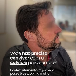 A calvície não precisa definir a forma como você se enxerga. ✨

Entradas mais aparentes, linha front