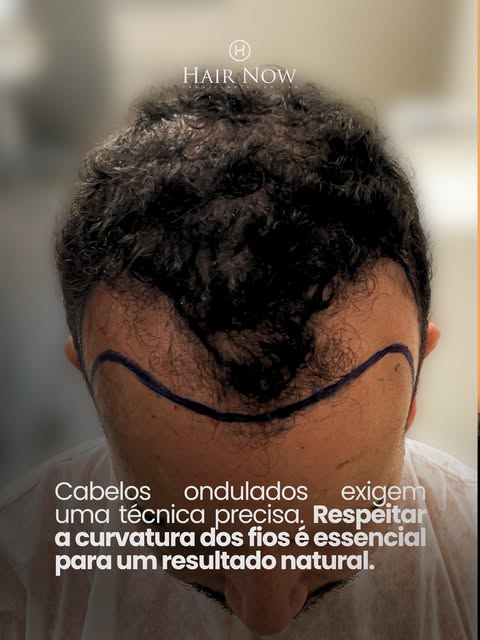 Cada fio tem sua particularidade e o tratamento também deve ter.

Em cabelos ondulados, respeitar a 