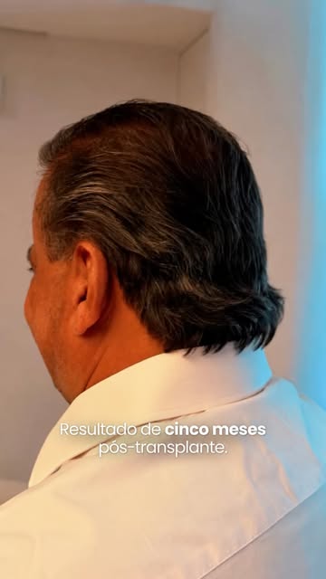 5 meses após a cirurgia, e a satisfação já fala por si!

Cada paciente tem seu próprio processo de e
