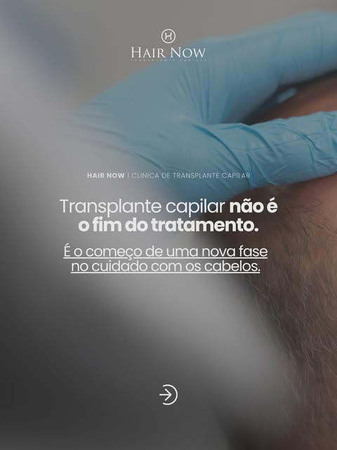 O transplante capilar pode transformar a aparência, mas o cuidado com os fios não termina quando o p