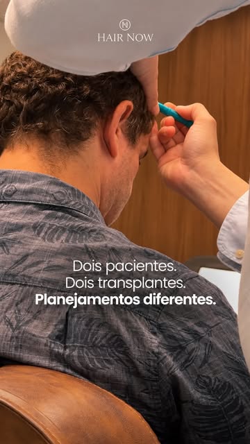 Dois pacientes podem fazer um transplante capilar e passar por cirurgias completamente diferentes. �