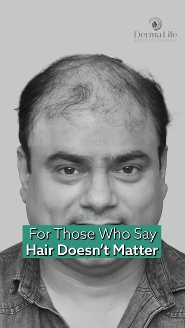 Your hair is one of the first things people notice. 
Natural-looking hair. Better density. A hairlin