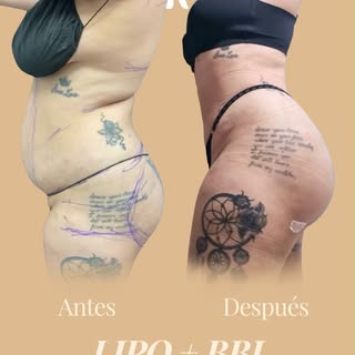 Una transformación que se ve. ✨

Este antes y después de Lipo + BBL muestra cómo podemos trabajar la