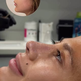 Tu perfil puede cambiar, sin dejar de ser tú. ✨

La rinoplastia busca armonizar los rasgos del rostr