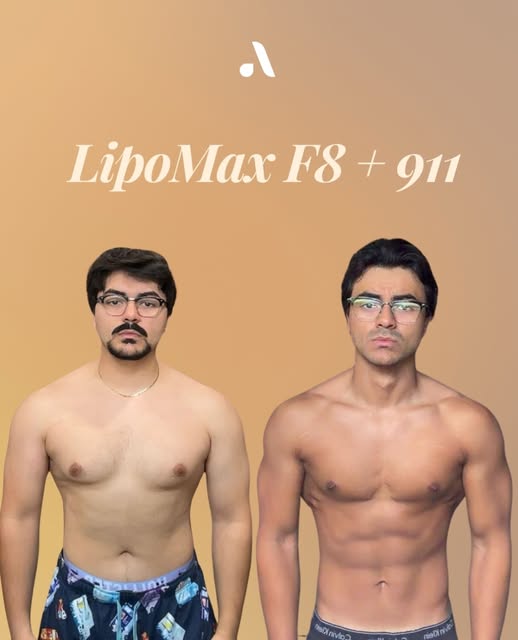 Lipo Max F8 + 911 combina un procedimiento corporal con un protocolo enfocado en acompañar tu proces