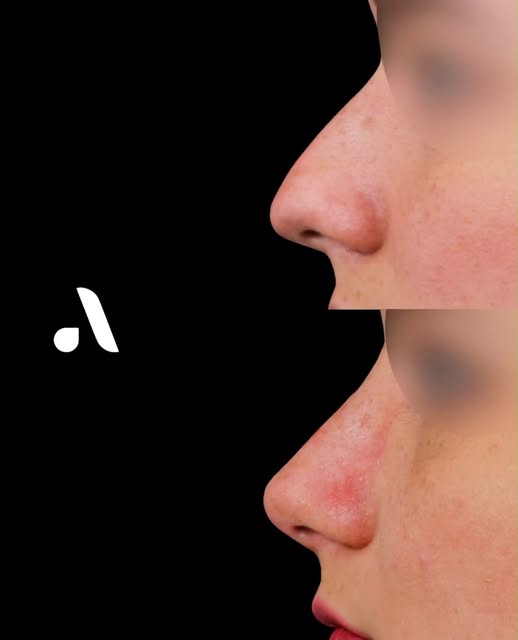 ✨ Armoniza tus rasgos sin dejar de ser tú.

La rinoplastia puede ayudarte a lograr un perfil más equ