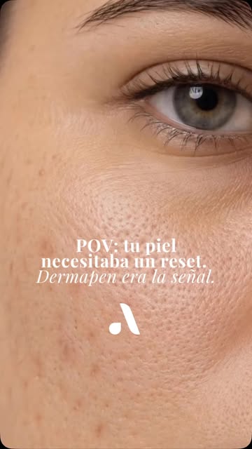 ✨ Una piel más renovada empieza con estimular lo que ya tiene.

Dermapen 4 crea microcanales preciso