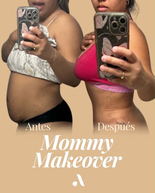 ✨ Un cambio que empieza por cómo quieres volver a sentirte.

Este antes y después de Mommy Makeover 