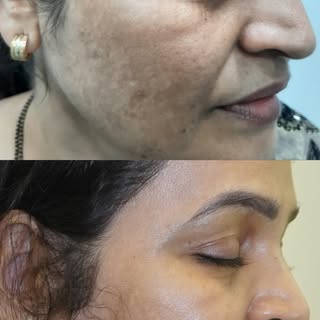 Book your appointment today 💌 

Our client Farida had been struggling with stubborn pigmentation fo