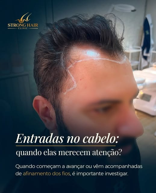 As entradas no cabelo podem fazer parte do formato natural da linha capilar. O sinal de atenção é qu