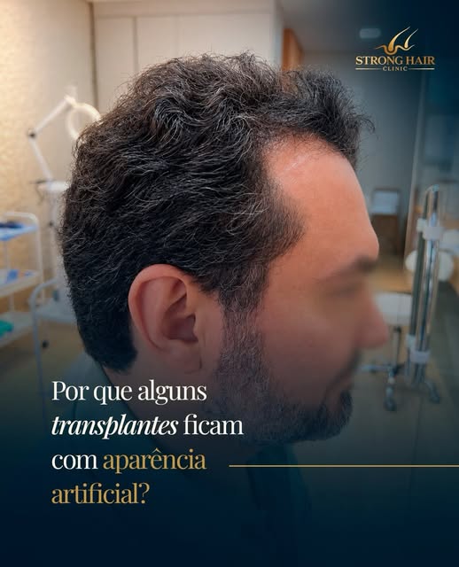 O resultado de um transplante capilar está nos detalhes.

Linha frontal muito marcada, direção errad