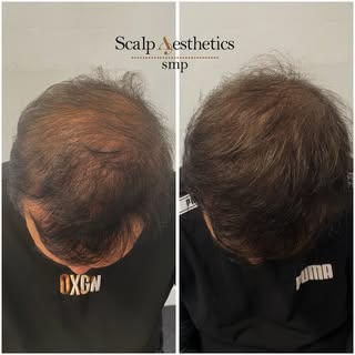 ✨ Healed results after 3rd session of Scalp Micropigmentation ✨
When working with longer hair, SMP b