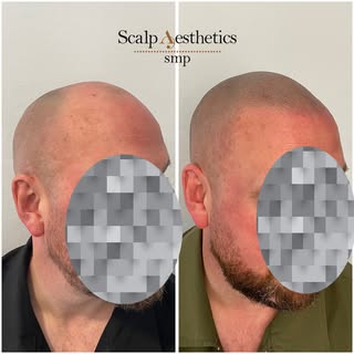 ✨ Transform Your Look with SMP ✨
Tired of thinning hair or bald spots holding you back?
Scalp Microp
