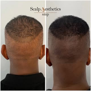 🚨 Over-Harvested Donor Area After Hair Transplant 🚨
These images show how excessive graft extracti