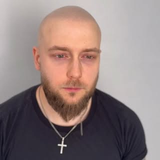 ✨ New hairline, new confidence – in just 6–8 weeks! 💇‍♂️
Scalp Micropigmentation is the game change